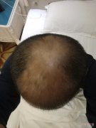 我chudi在科发源植发两年多失败了，机构还到处封帖