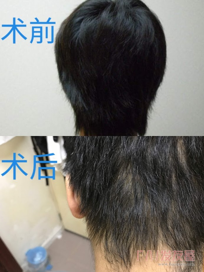 后枕术前术后.jpg