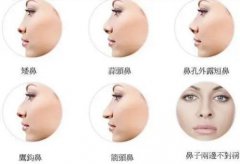 王海木院长的鼻整形扫盲贴士